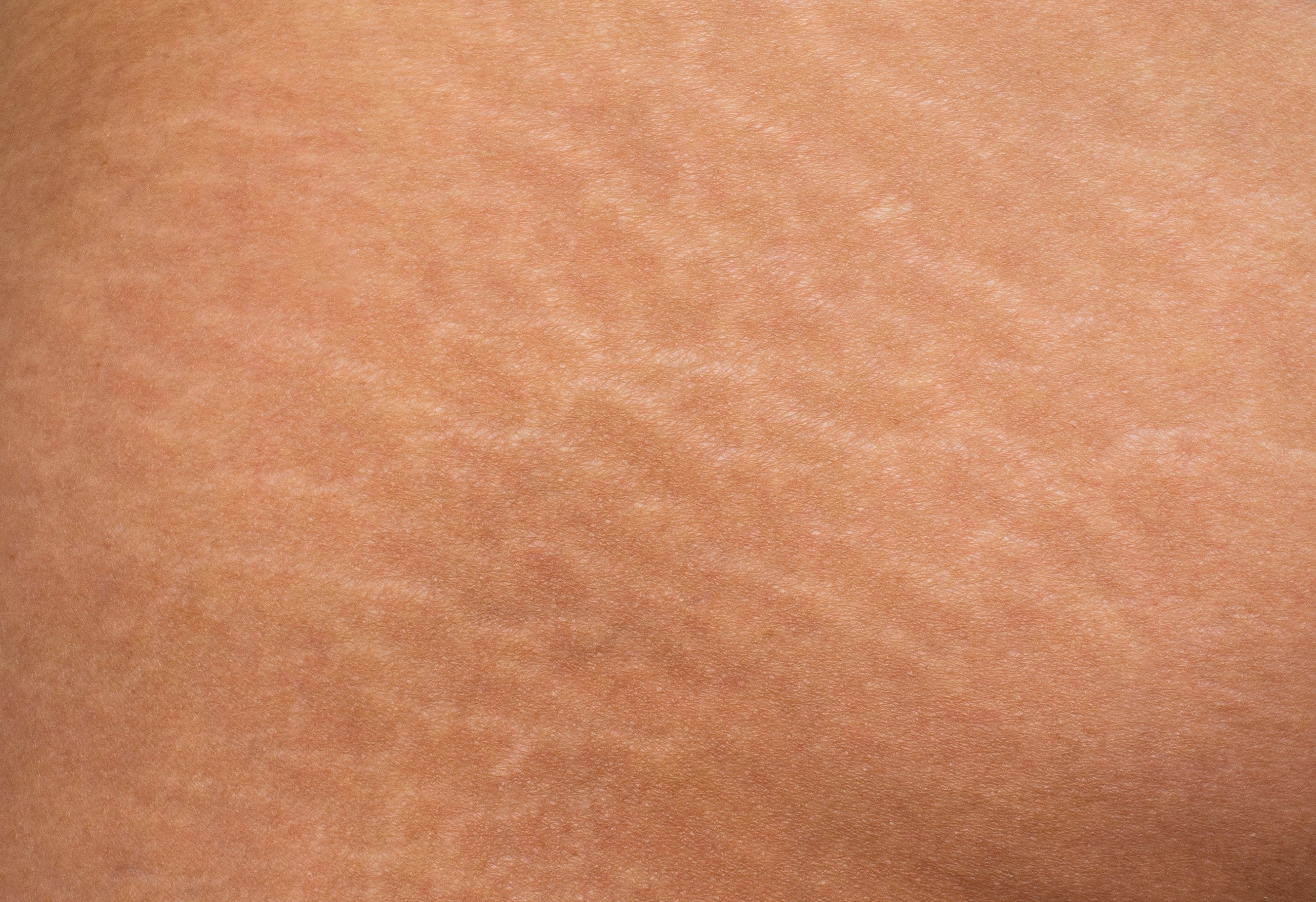 Stretchmarks Camoflauge Tattoo - 7L Micropigmentation Cartridges - 10 pieces + 3 pieces Color Correction Serum Set.