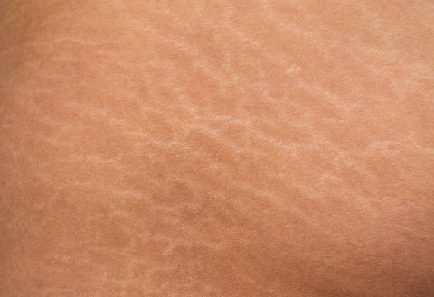 7L Micropigmentation Cartridges for Stretchmarks Camoflauge