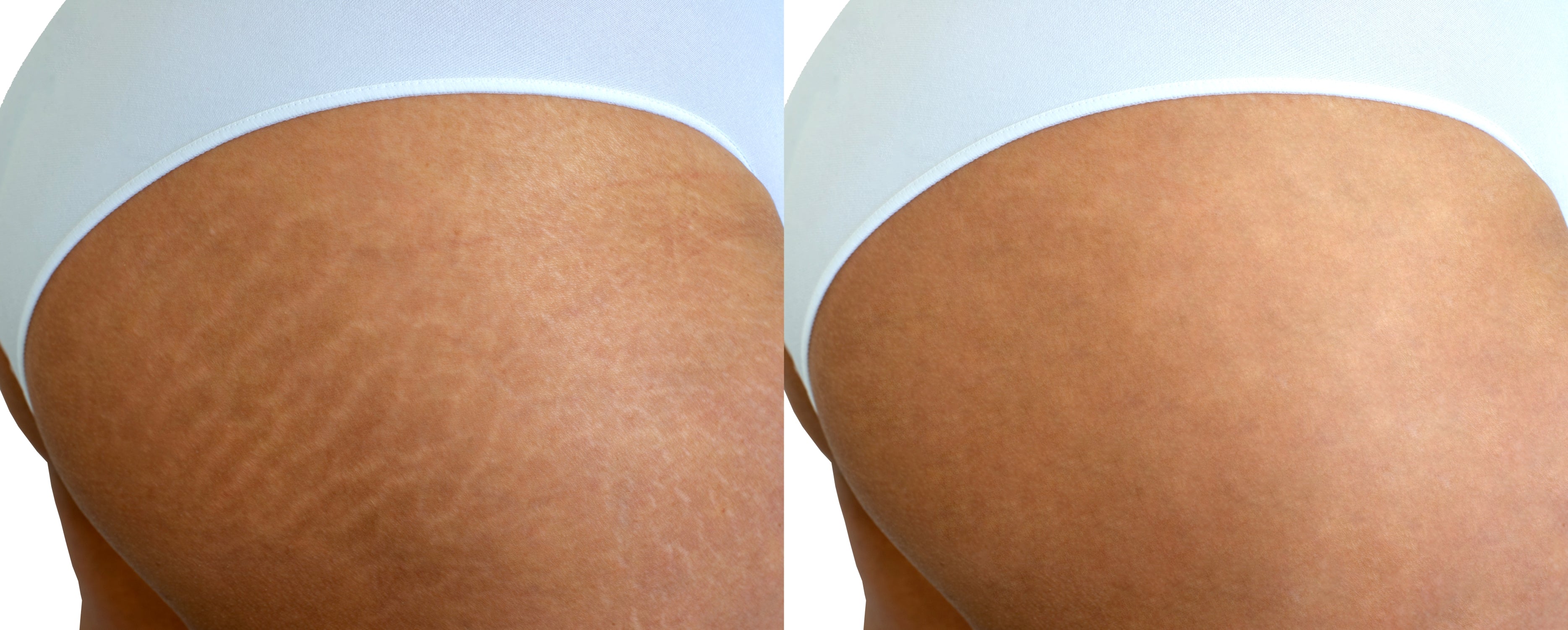 iLLUMAPRO Stretchmark Camouflage Tattoo Kit