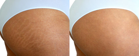 7L Micropigmentation Cartridges for Stretchmarks Camoflauge